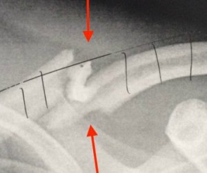 Une nouvelle thérapie pour réparer et consolider les os