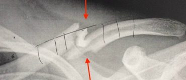 Une nouvelle thérapie pour réparer et consolider les os