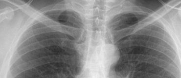 Le machine learning, appliqué à l’imagerie médicale