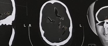 Détecter des AVC grâce à des échographies transcrâniennes