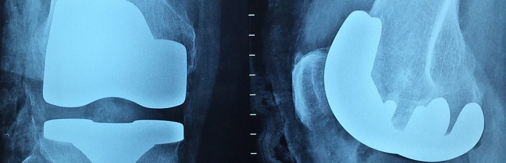 L'impression 3D pour des implants antibactériens