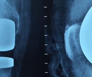 L'impression 3D pour des implants antibactériens