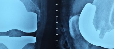 L'impression 3D pour des implants antibactériens