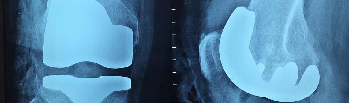 L'impression 3D pour des implants antibactériens
