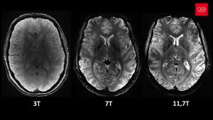 Différences de résolutions d'images de coupes du cerveau humain prises avec une IRM d'un champ magnétique de 3 T (teslas), 7 T et 11,7 T (pour un même temps d'acquisition). Crédit : CEA