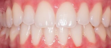 Un médicament pour faire repousser les dents ?