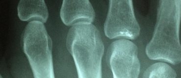 Un nanocomposite biodégradable et imprimable en 3D, pour la greffe osseuse