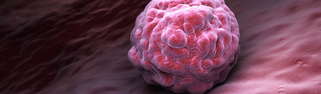 IA et recherche contre le cancer : six innovations inspirantes