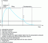 Figure 14 - Monitoring the pressure in a beer keg during filling using the phase imbalance principle