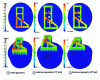 Figure 31 - Results of a 3D calculation: isovitesses map (in mm/s) in a profile die and its reservoir (initial geometry and modifications to rebalance the flow)