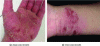 Figure 15 - The two types of dermatitis (source: Cetim)