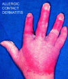 Figure 2 - Example of allergic dermatitis