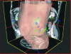 Figure 11 - Renal puncture planning with metrics