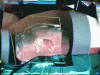 Figure 8 - Video projection of iliac crests on the patient's body in the operating room