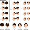 Figure 7 - Modification of the scale for measuring the degree of alopecia in men (Hamilton Norwood classification)