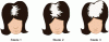 Figure 8 - Representation of the three stages of female alopecia