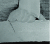 Figure 15 - Cracking at the base of the bead due to an overflow defect