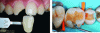 Figure 29 - Use of a shade guide to best adjust the shade of the restorative
composite. Colored composite mimicking dentin for the restoration
of a posterior tooth (source of illustrations [16])