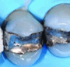 Figure 33 - Examples of restorations with amalgam (source of
illustrations [16])