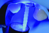 Figure 36 - Sealing of a dental post in a devitalized tooth by light-curing
of a resin cement (source of illustrations [16])