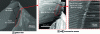 Figure 11 - SEM photos illustrating aluminum bonding to the cutting edges of an uncoated Ref. 3 tool after drilling at a feed rate of 0.05 mm.tr-1 and a rotation speed of 1,050 rpm-1