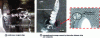 Figure 4 - Problems encountered when drilling a CFRP/A1 using tools Ref. 1, Ref. 2 and Ref. 3 with a feed rate of 0.05 mm.tr-1 and a rotation speed of 2,750 rpm-1