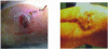 Figure 13 - Allergies to metals in orthopedic prostheses (SOFCOT 2006 –. F. Délépine, H. Corneville, and G. Délépine)