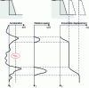 Figure 37 - Calculation of irreversible displacements undergone by a retaining wall using a rigid block model of the "Newmark" type.