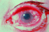Figure 8 - Severely irritated eye with mild corneal abrasion