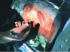 Figure 14 - Use of PTM3D in the operating room during percutaneous lateral nephrolithotomy