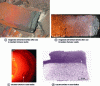 Figure 13 - Other examples of slag infiltration in carbon-free refractories (porosity impregnation) and consequences