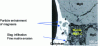 Figure 9 - Erosion of the matrix of an MgO-C refractory in contact with CaO-Al2O3 slag (laboratory experiment)