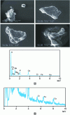 Figure 12 - Bone particles extracted from an inflammatory pannus bearing traces of metal (according to [31])